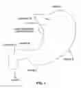 Fig. 02 - Gastro-esophageal implants