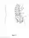 Fig. 02 - DEXAMETHASONE POLYMER IMPLANT FOR PAIN