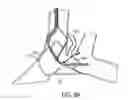 Fig. 07 - System and method for treatment of pulmonary edema