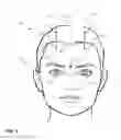 Fig. 02 - METHODS AND HEAD-MOUNTED DEVICES FOR PAIN RELIEF BY STIMULATING TREATMENT LINES ALONG THE SCALP