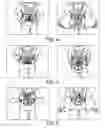 Fig. 05 - Rapidly removable gloves and related methods