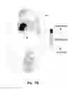 Fig. 14 - In-Shoe Support Device For Heeled Shoes