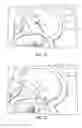 Fig. 10 - DIRECT VIEW OPTICAL CARDIAC CATHETER