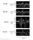 Fig. 05 - Device and method for in vivo noninvasive magnetic manipulation of circulating objects in bioflows