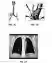Fig. 03 - Method for determining a respiratory condition based on functional respiratory imaging