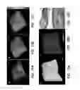 Fig. 09 - Integrated multimodality intravascular imaging system that combines optical coherence tomography, ultrasound imaging, and acoustic radiation force optical coherence elastography