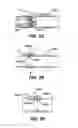 Fig. 10 - Devices for sealing a body lumen