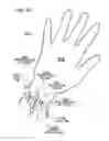 Fig. 101 - METHODS AND DEVICES TO DECREASE TISSUE TRAUMA DURING SURGERY
