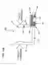 Fig. 133 - METHODS AND DEVICES TO DECREASE TISSUE TRAUMA DURING SURGERY