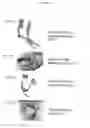 Fig. 84 - METHODS AND DEVICES TO DECREASE TISSUE TRAUMA DURING SURGERY