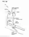 Fig. 94 - METHODS AND DEVICES TO DECREASE TISSUE TRAUMA DURING SURGERY