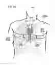 Fig. 98 - METHODS AND DEVICES TO DECREASE TISSUE TRAUMA DURING SURGERY