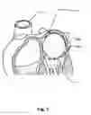 Fig. 06 - Temporary Atrium Support Device