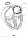 Fig. 07 - Temporary Atrium Support Device