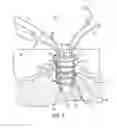 Fig. 03 - Anti-backup suture anchor