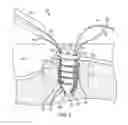 Fig. 06 - Anti-backup suture anchor