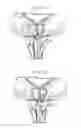 Fig. 04 - System with reloadable handle for delivering an anchor