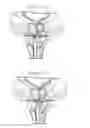 Fig. 05 - System with reloadable handle for delivering an anchor