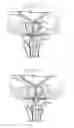 Fig. 06 - System with reloadable handle for delivering an anchor