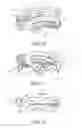 Fig. 17 - Laparoscopic suture device with release mechanism