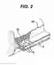 Fig. 03 - Methods and Devices for Reinforcing a Staple Line