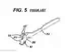 Fig. 06 - Methods and Devices for Reinforcing a Staple Line