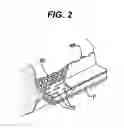 Fig. 03 - Methods and devices for reinforcing a staple line