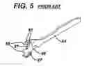 Fig. 06 - Methods and devices for sealing stapled tissue