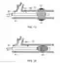 Fig. 08 - LOW RADIAL FORCE VASCULAR DEVICE AND METHOD OF OCCLUSION