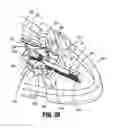 Fig. 35 - Surgical clip applier