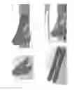 Fig. 44 - Surgical clip applier