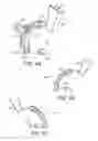 Fig. 09 - ELBOW RECONSTRUCTION INSTRUMENTS