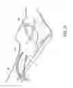 Fig. 11 - ELBOW RECONSTRUCTION INSTRUMENTS