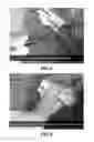 Fig. 06 - Aortic arch reconstruction device and method of using same