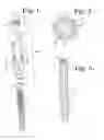 Fig. 02 - Polyaxial bone anchor with insert guides