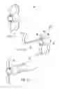 Fig. 06 - Spinal implants and methods