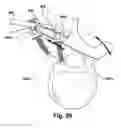 Fig. 28 - Tether clamp and implantation system