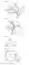 Fig. 10 - Catheter for denervation