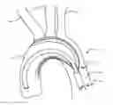 Fig. 01 - Aortic great vessel protection