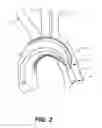Fig. 04 - Aortic great vessel protection