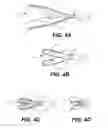 Fig. 05 - Aortic great vessel protection
