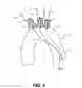 Fig. 07 - Aortic great vessel protection
