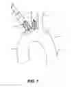 Fig. 08 - Aortic great vessel protection