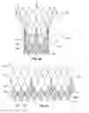Fig. 04 - Stent cell bridge for cuff attachment