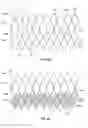 Fig. 07 - Stent cell bridge for cuff attachment