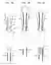 Fig. 09 - VENTRICULARLY-ANCHORED PROSTHETIC VALVES