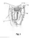 Fig. 02 - System for cardiac valve repair