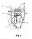 Fig. 04 - System for cardiac valve repair