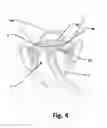 Fig. 05 - System for cardiac valve repair