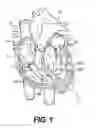 Fig. 02 - Devices for remodeling a valve annulus and ventricle